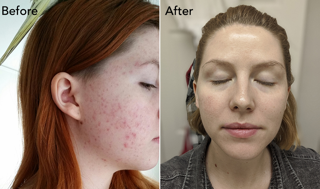 Skincare routine for acne prone sensitive skin 