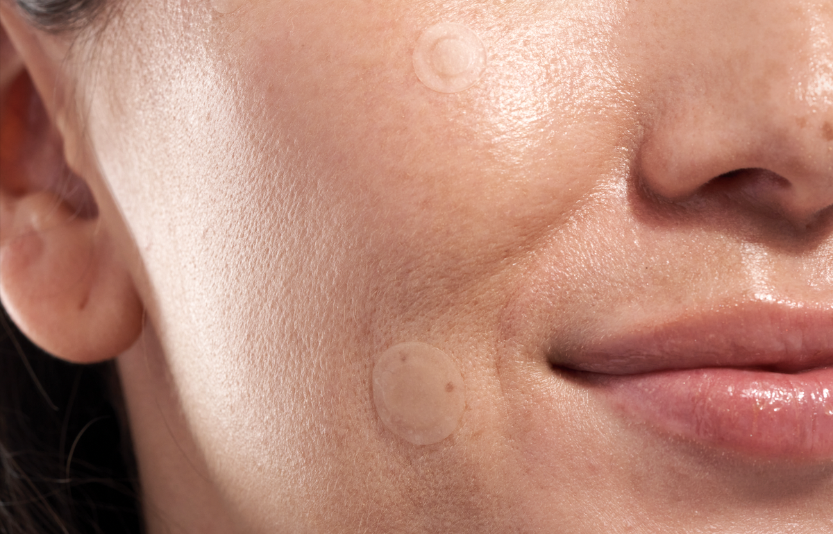 Conquer Post-pimple Pigmentation with The Klog's new Soft Shield